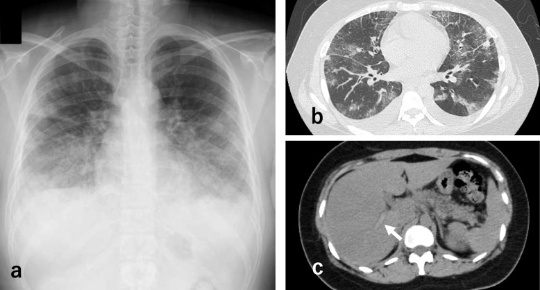 Benralizumab for acute thromboembolism in hypereosinophilic syndrome: a case report.