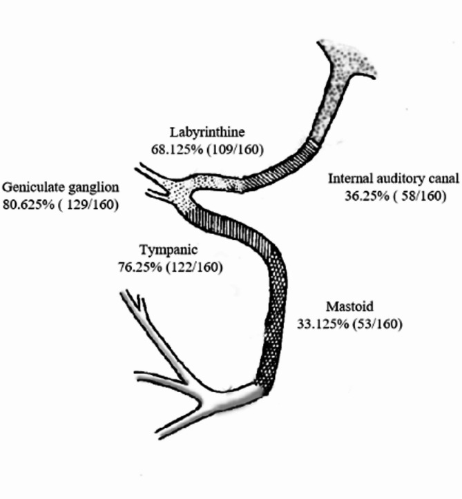 Outcome of different facial nerve managements in petrous bone cholesteatoma patients with facial paralysis.