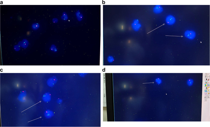 Evaluation of the predictors of successful sperm retrieval of micro-TESE in cases with mosaic Klinefelter versus cases with non-mosaic Klinefelter: a prospective case series study.