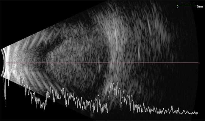 Early Drainage of Macula-Involving Massive Suprachoroidal Haemorrhage Assisted with Recombinant Tissue Plasminogen Activator May Lead to Better Visual Prognosis.