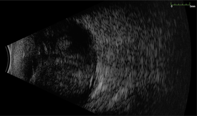 Early Drainage of Macula-Involving Massive Suprachoroidal Haemorrhage Assisted with Recombinant Tissue Plasminogen Activator May Lead to Better Visual Prognosis.