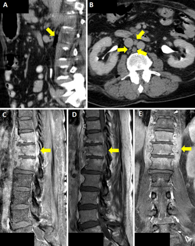 Fever of unknown origin: multidrug-resistant <i>Escherichia coli</i> presenting as infectious spondylodiscitis.