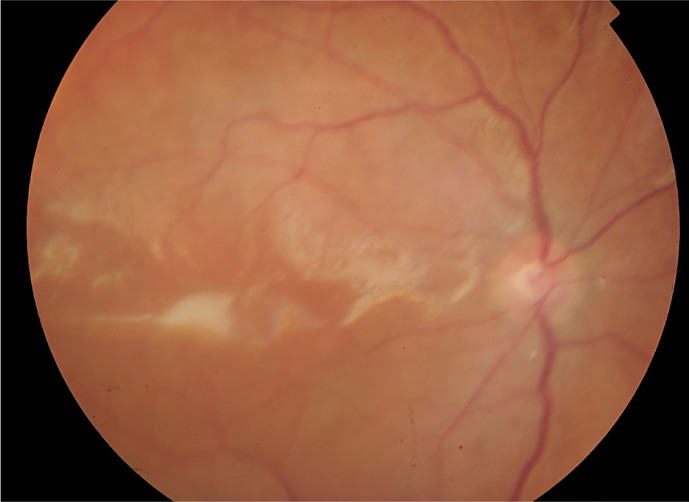 Early Drainage of Macula-Involving Massive Suprachoroidal Haemorrhage Assisted with Recombinant Tissue Plasminogen Activator May Lead to Better Visual Prognosis.