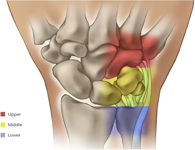 Ulnar-Sided Wrist Pain: Systematic Clinical Approach and Principles of Treatment.