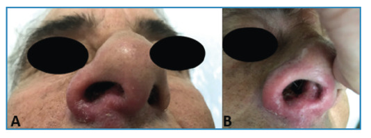 Mycetoma-like cutaneous leishmaniasis.