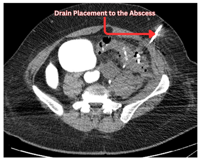 Diverticular Abscess and Percutaneous Drainage Outcomes: A Review of Clinical Practice for the Primary Team.