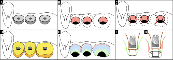 Implant supracrestal complex conditioning through the "x technique" to achieve an enhanced muco-cervical imprint. Case reports.
