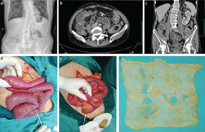 Trans-visceral Migration of Retained Gauze: A Rare Cause of Intestinal Obstruction