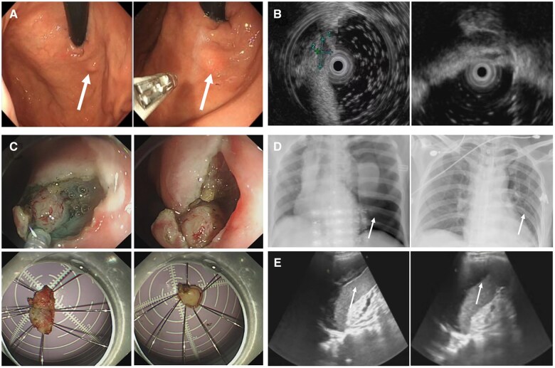 Gas in endoscopic full-thickness resection: a potential culprit in combined thoracoabdominal injury?