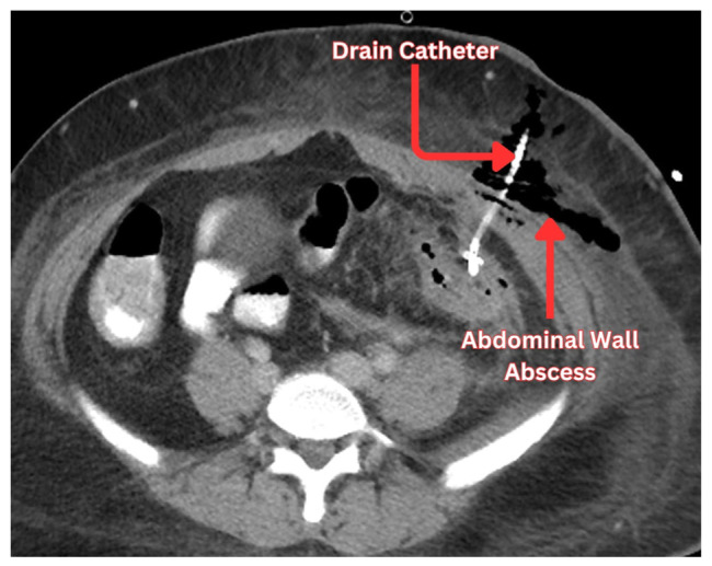 Diverticular Abscess and Percutaneous Drainage Outcomes: A Review of Clinical Practice for the Primary Team.
