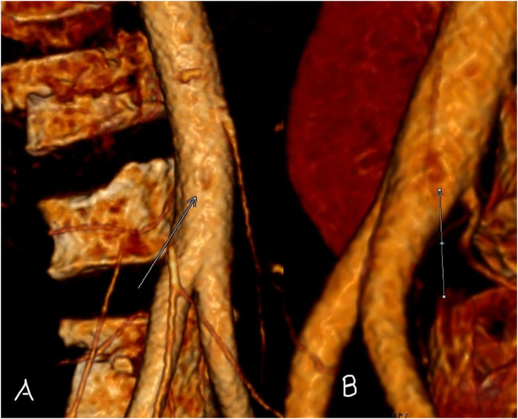 The 'DIMPLE SIGN' of Intra-Aortic Cord.