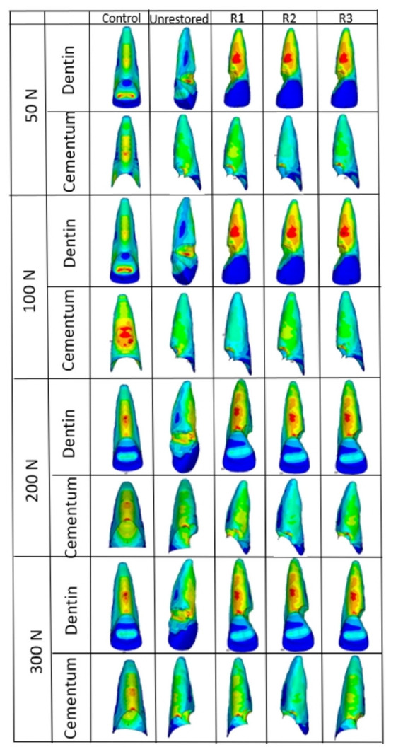 Stress distribution of restorations in external cervical root resorption under occlusal and traumatic loads: a finite element analysis.