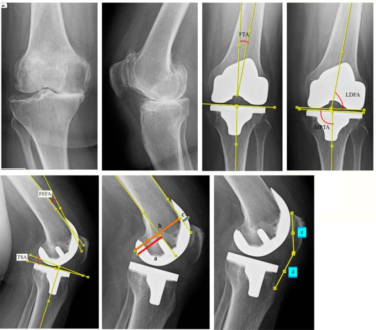 Functional outcome comparison of single-radius and multi-radius femur in total knee arthroplasty.