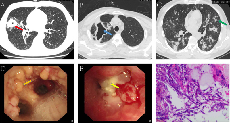 Diagnosis, clinical features, and mortality risk factors in a Chinese cohort with pulmonary mucormycosis.