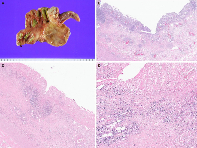 Histopathological characteristics of Epstein-Barr virus (EBV)-associated encephalitis and colitis in chronic active EBV infection.