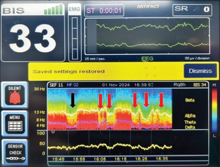 Impact of inferior vena cava clamping on electroencephalographic change during anaesthesia.