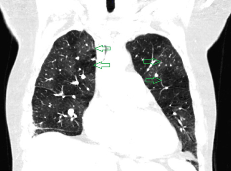 Chronic thromboembolic hypertension predictors in computed tomography angiography. Single-centre study.