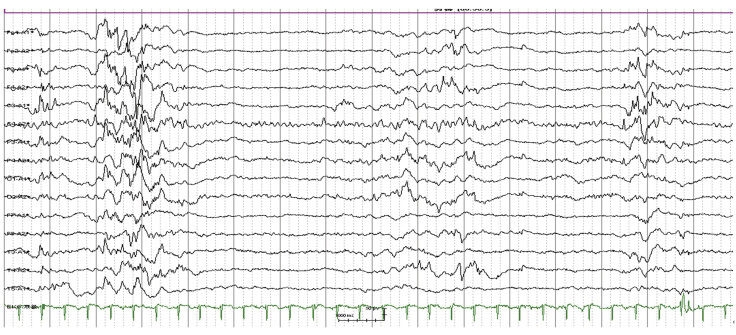 The Application Value of Early Amplitude-Integrated Electroencephalogram in a Newborn with Nonketotic Hyperglycinemia: A Rare Case Report.