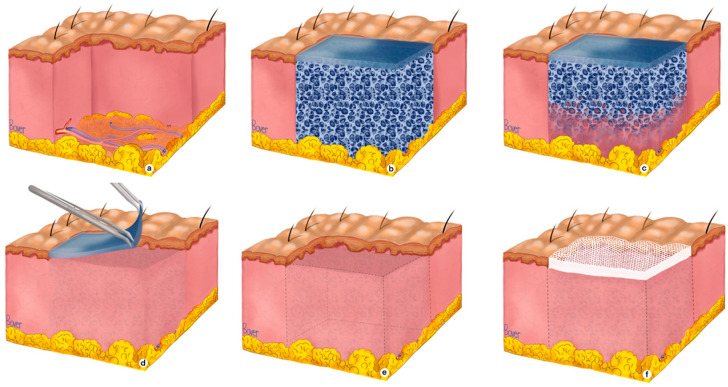 The Reconstruction of Various Complex Full-Thickness Skin Defects with a Biodegradable Temporising Matrix: A Case Series.