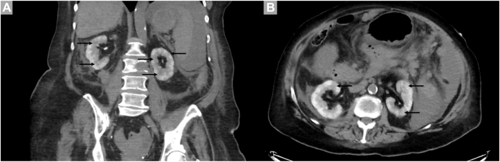 Clinical Implications of Striated Nephrogram in Patients Receiving Immune Checkpoint Inhibitors for Cancer.