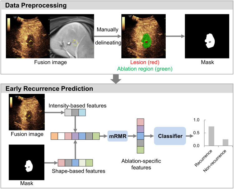 Can Intra-Operative Ablation-Specific Features Based on Ultrasound Fusion Imaging be Used to Predict Early Recurrence of Hepatocellular Carcinoma After Microwave Ablation: A Proof-of-Concept Study.