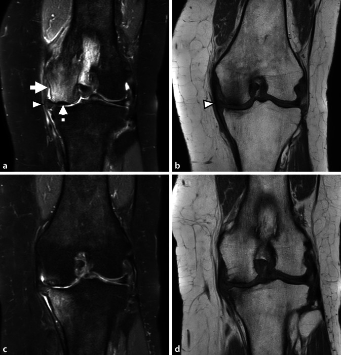 Bone marrow lesions related to bone marrow edema syndromes and osteonecrosis.