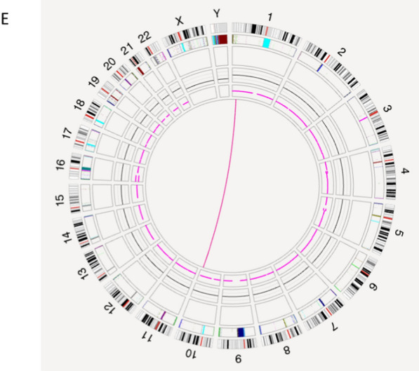 Optical genome mapping enhances cytogenetic analysis in recurrent miscarriage: confirmation of a suspected (1;10) chromosomal translocation.