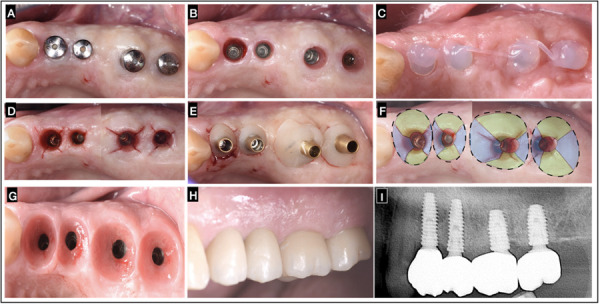 Implant supracrestal complex conditioning through the "x technique" to achieve an enhanced muco-cervical imprint. Case reports.
