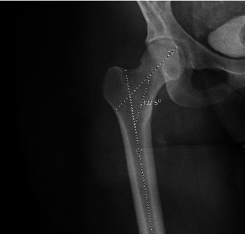 Variations in Greater Trochanter Height as a Relation to Patient Demographics: Implications for Femoral Nail Design.
