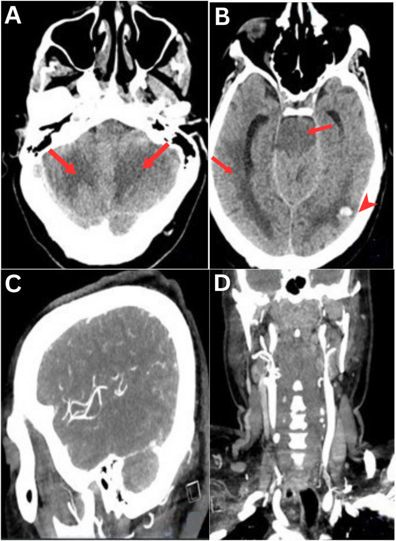 Anti-Neutrophil Cytoplasmic Antibody-Associated Central and Peripheral Nervous System Vasculitis.