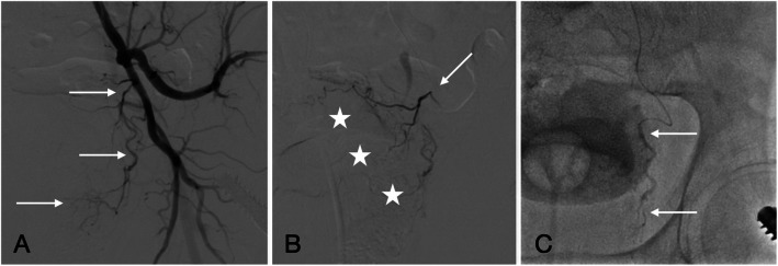 Predicting early clinical success of prostate artery embolization using MRI perfusion in benign prostatic hyperplasia.