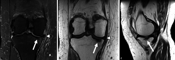 Bone marrow lesions related to bone marrow edema syndromes and osteonecrosis.