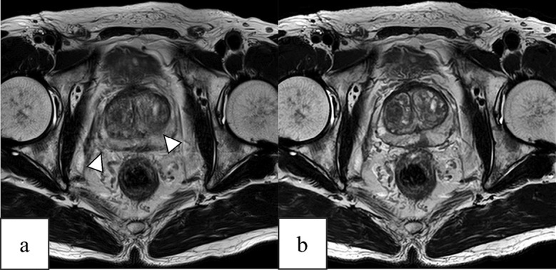 Deep-learning reconstruction of the prostate improves image quality and acquisition time in T2-weighted imaging.
