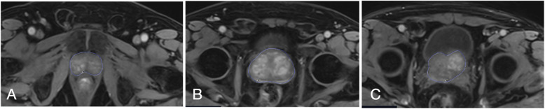 Predicting early clinical success of prostate artery embolization using MRI perfusion in benign prostatic hyperplasia.