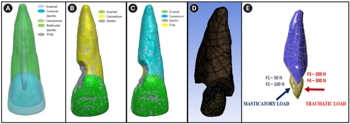 Stress distribution of restorations in external cervical root resorption under occlusal and traumatic loads: a finite element analysis.