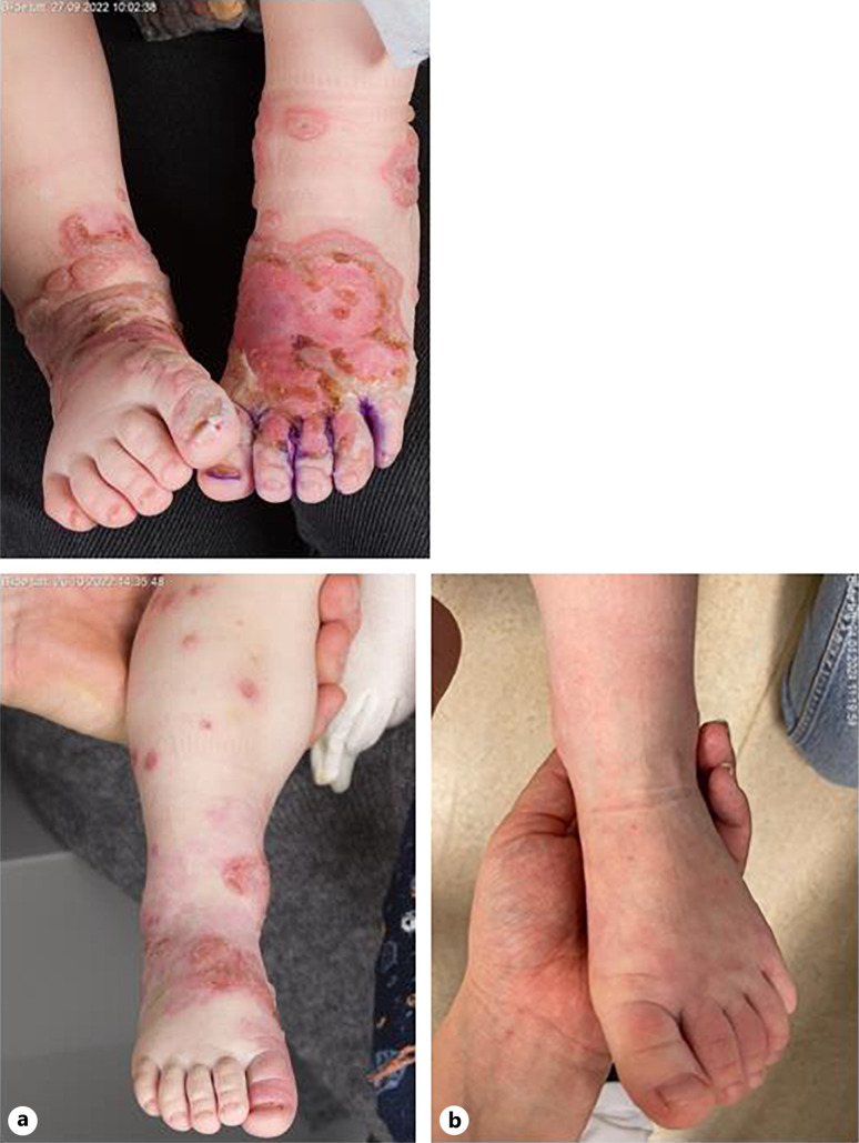 Childhood Linear IgA Dermatosis Successfully Treated with the Combination of Dapsone and Sulfasalazine.