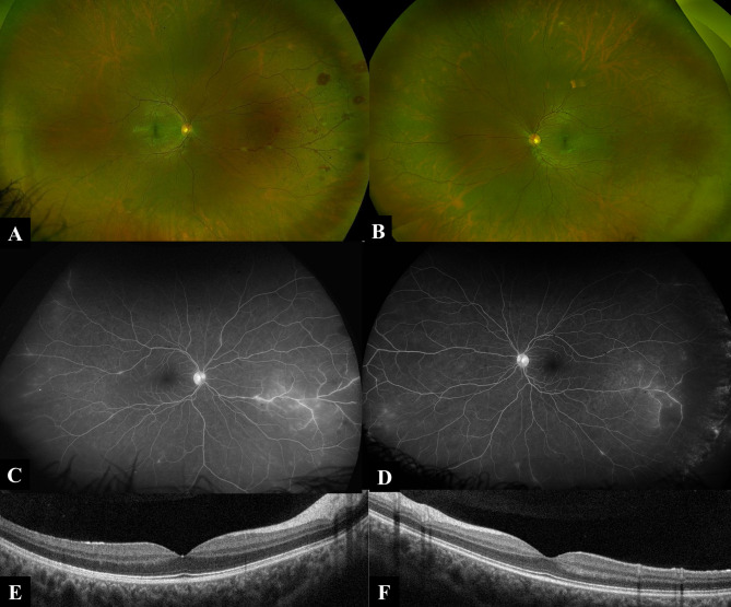 Concurrent uveitis in monozygotic twins in the context of systemic sarcoidosis.