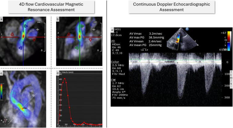 Four-dimensional flow provides incremental diagnostic value over echocardiography in aortic stenosis.