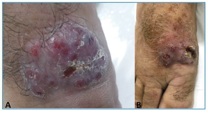 Mycetoma-like cutaneous leishmaniasis.