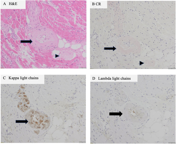 Vascular-variant cardiac amyloid: Cardiac MRI and histopathological appearances.