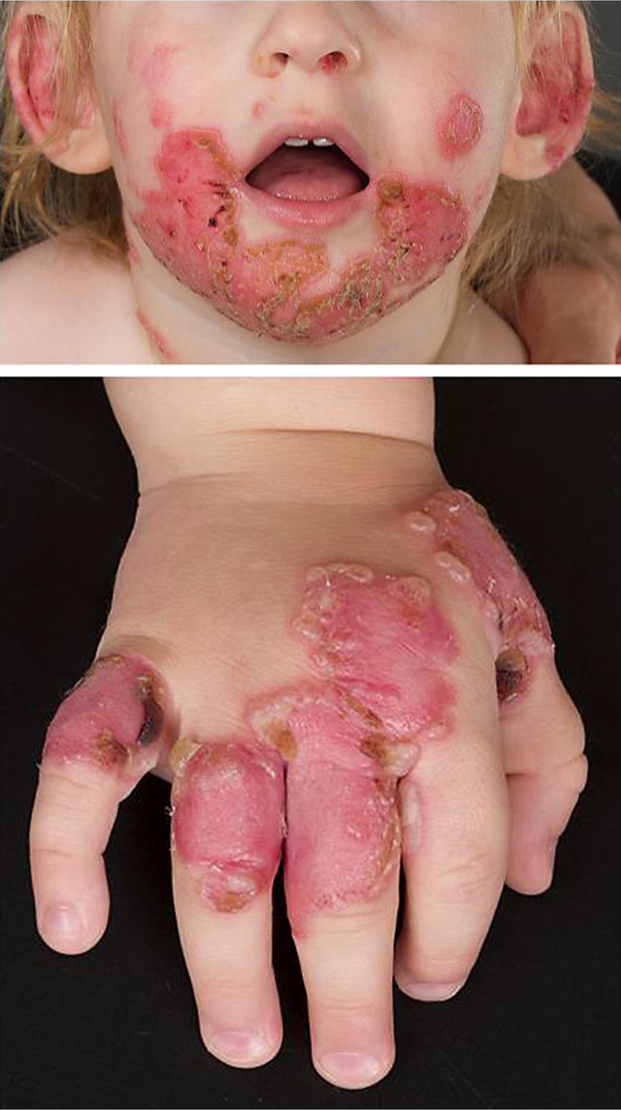 Childhood Linear IgA Dermatosis Successfully Treated with the Combination of Dapsone and Sulfasalazine.