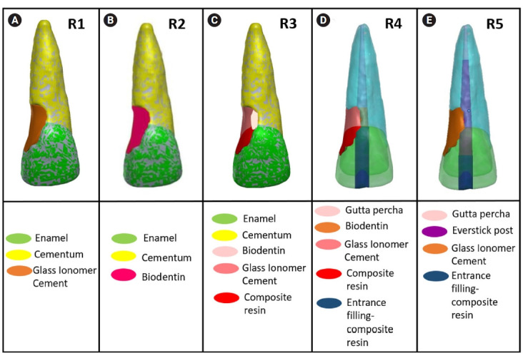 Stress distribution of restorations in external cervical root resorption under occlusal and traumatic loads: a finite element analysis.