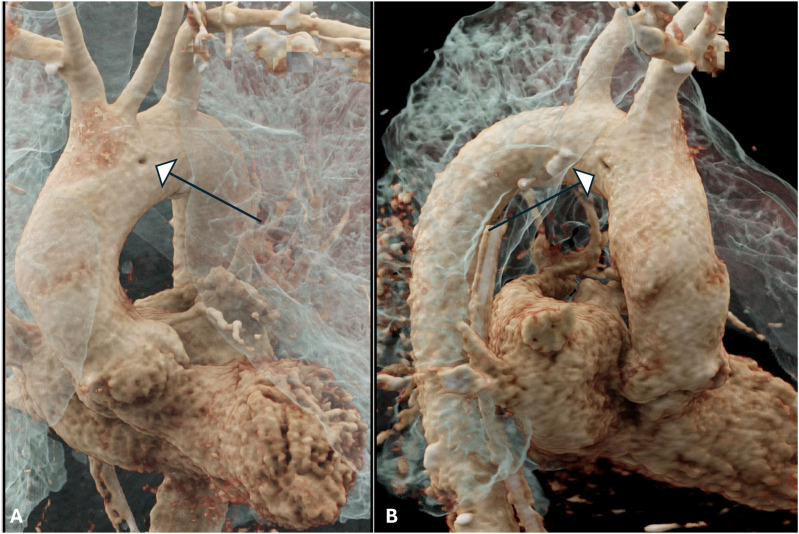 The 'DIMPLE SIGN' of Intra-Aortic Cord.