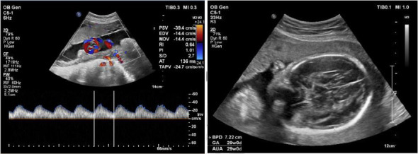 Multidisciplinary Management of Pituitary Neuroendocrine Tumors During Pregnancy: Institutional Report.