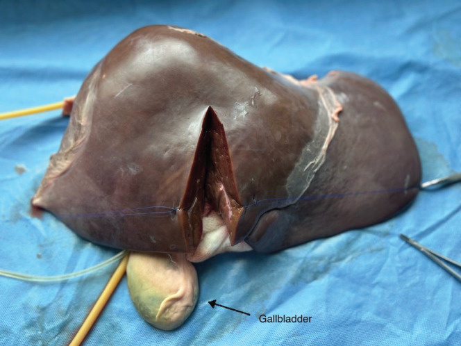 Creating a sustainable and inexpensive dry animal training model for liver surgery in low- and middle-income countries.