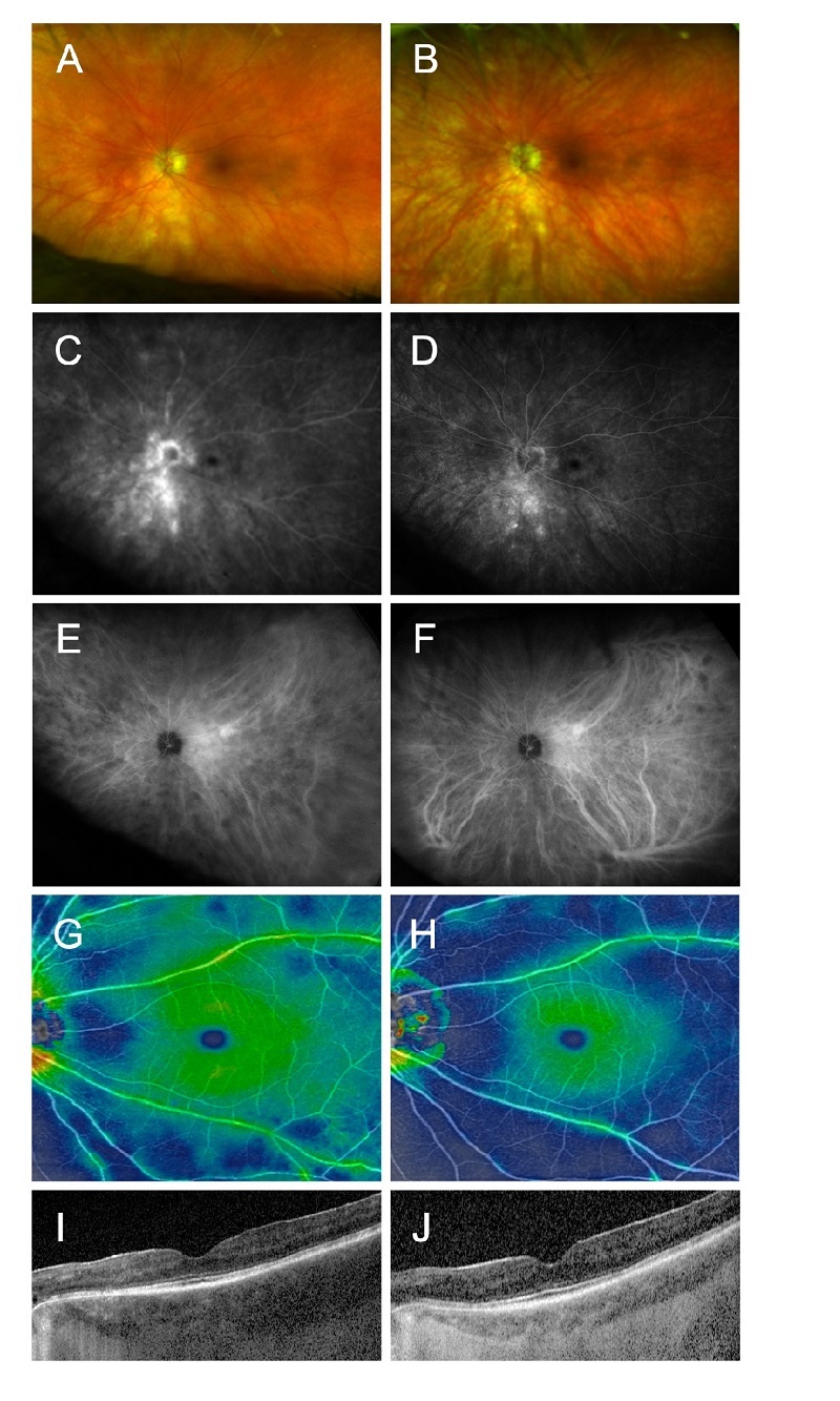 Successful Use of Upadacitinib, a Selective JAK Inhibitor, in the Treatment of Two Cases of Recalcitrant Chronic Uveitis.
