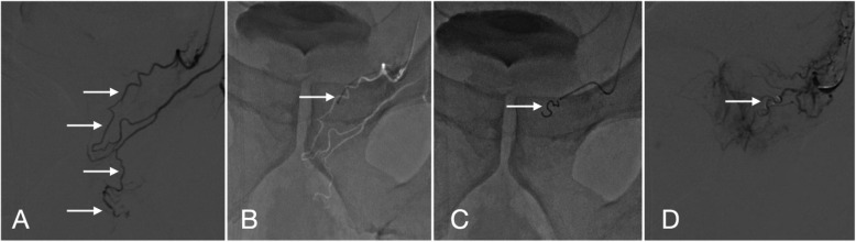Predicting early clinical success of prostate artery embolization using MRI perfusion in benign prostatic hyperplasia.