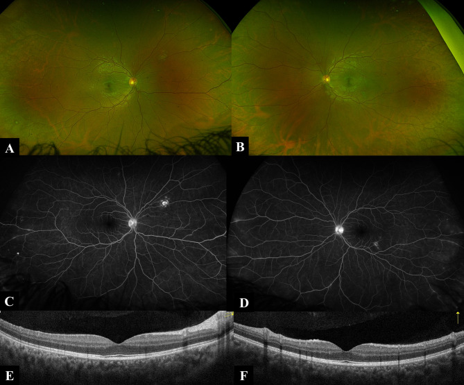 Concurrent uveitis in monozygotic twins in the context of systemic sarcoidosis.