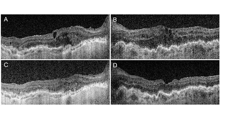 Successful Use of Upadacitinib, a Selective JAK Inhibitor, in the Treatment of Two Cases of Recalcitrant Chronic Uveitis.