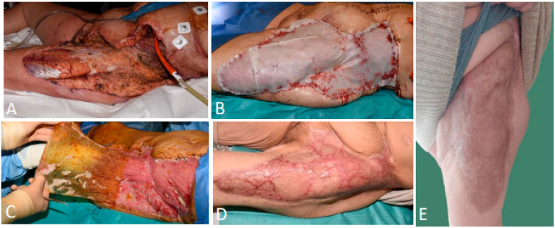 The Reconstruction of Various Complex Full-Thickness Skin Defects with a Biodegradable Temporising Matrix: A Case Series.